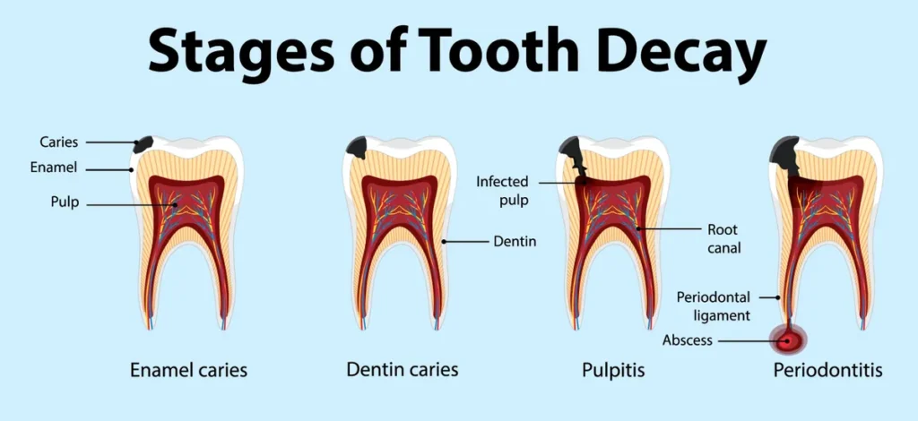 Illustration showing the stages of tooth decay