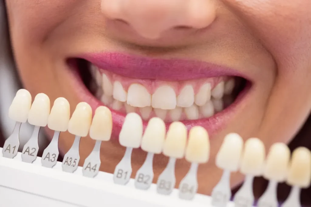 A Dentist’s Guide to Teeth Whitening in Singapore: Everything You Need to Know