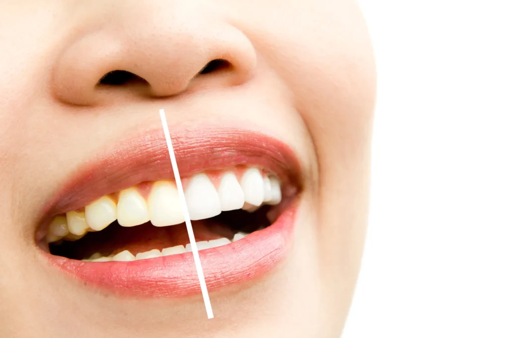 How to Remove Yellow Stains From Teeth: What Actually Works
